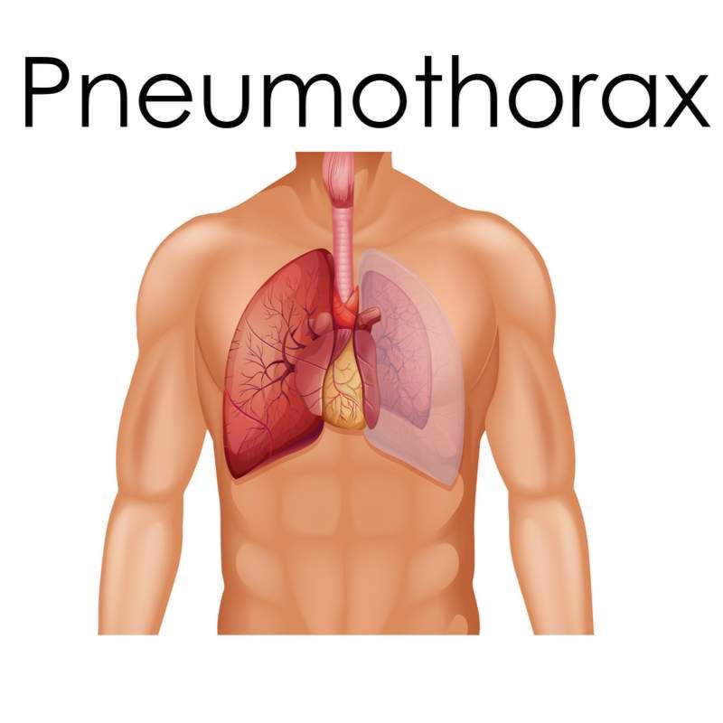 Pertolongan Cemas Untuk Pneumothorax: Bagaimana Mariska Hargitay Menderita Paru-Paru Yang Runtuh Setelah Kejatuhan Mengejutkan Di Atas 'Undang-Undang & Ketertiban'