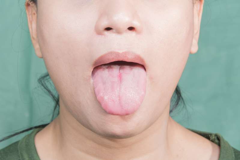 舌の信号の健康問題に歯がマークするのはいつですか？女性の地図状舌の病気
