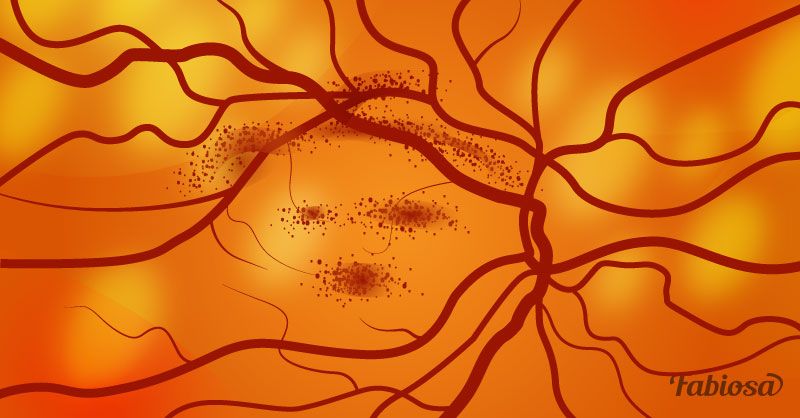 7 nerimą keliantys kraujo krešulio požymiai akyje ir kodėl jis toks pavojingas