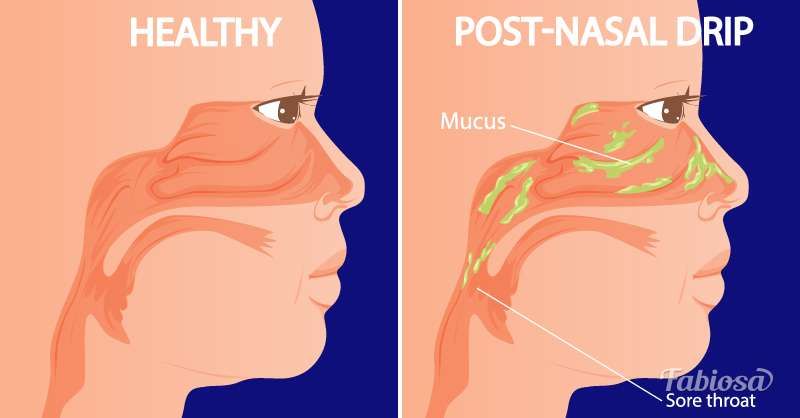 Jak uvolnit postnasální kapání bez nosních sprejů: 5 účinných přírodních léků
