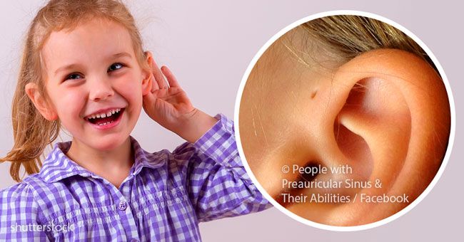 Per què algunes persones tenen petits forats a prop de les orelles i què significa per a la seva salut