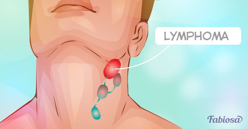 9 brīdinājuma pazīmes par limfomu, kurai jāpievērš uzmanība