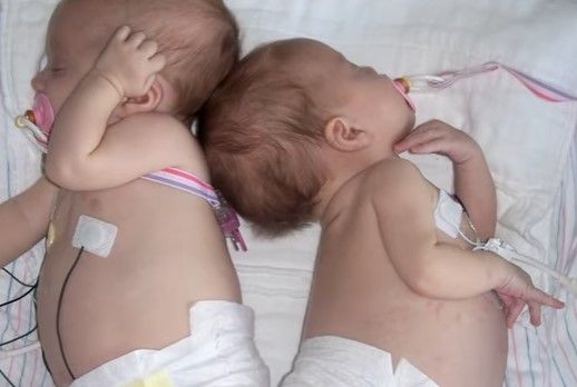 माता-पिता अपनी जुड़वां लड़कियों के रूप में गवाही साझा करते हैं, दुर्लभ घातक कैंसर से बचते हैं, जब वे उनकी चिकित्सा के लिए प्रार्थना करते हैं