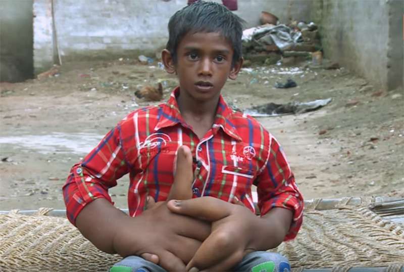 Parhaat lääkärit yrittävät pelastaa intialaisen pojan jättiläisillä käsillä elinikäisestä pilkasta